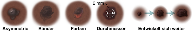 Muttermal mit asymmetrischer Form. Muttermal mit unebenen, verwaschenen Rändern. Muttermal mit dunklen und hellen Flecken. Muttermal mit einem Durchmesser von 6 mm. Drei Muttermale, die sich im Laufe der Zeit verändert haben.