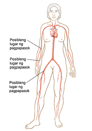 Anino ng babae na pinapakita ang mga lugar na pagpapasukan ng catheter sa singit at sa braso.