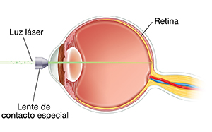 Vista lateral de un ojo que muestra la lente en el frente del ojo. Una luz láser se enfoca en la pared trasera interna del ojo.