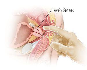 Mặt bên của các cơ quan vùng chậu của nam giới cho thấy cách kiểm tra trực tràng kỹ thuật số.