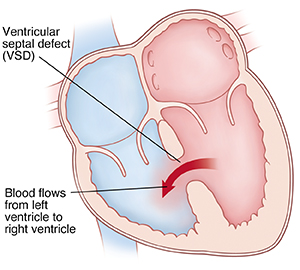 Cross section of heart showing ventricular septal defect (VSD) allowing blood to flow from left ventricle to right ventricle.