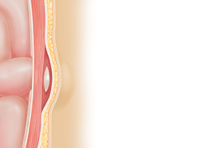 Cross section of body wall showing hernia. Intestine slightly protruding through defect in muscle underneath skin.