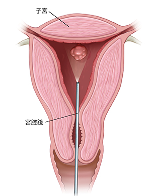 顯示宮腔鏡檢查的子宮橫截面。