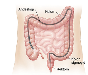 Viwonn abdomèn nan k ap montre pòte a (portée) ki ensere nan tout kolon an atravè tou dèyè a.