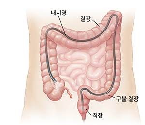 항문을 통해 결장 전체에 내시경이 삽입되어 있는 복부의 대략적 모습.