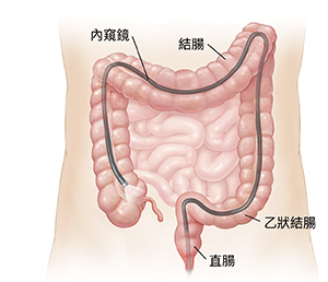 腹部輪廓圖，顯示通過肛門插入整個結腸的結腸鏡。