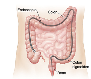 Profilo di un addome con l’endoscopio inserito attraverso l'ano nell'intero colon.