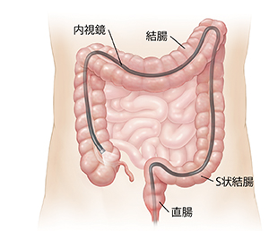 肛門から結腸全体に挿入された内視鏡を示す腹部の略図。