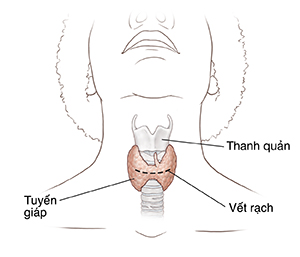 Mặt trước của đầu và cổ cho thấy tuyến giáp và vị trí rạch.