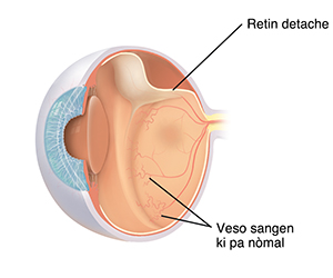 Yon imaj an koup transvèsal twa ka je a k ap montre yon retinopati kay yon ti bebe ki fèt anvan lè.