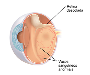 Corte transversal da vista de três quartos do olho, mostrando retinopatia da prematuridade.