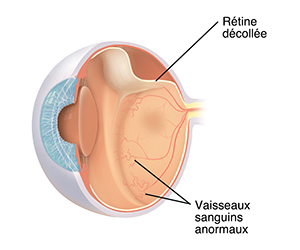 Vue en coupe de trois quarts de l'œil montrant une rétinopathie du prématuré.
