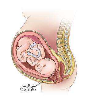 صورة جانبية للجنين في الرحم تُظهر أنَّ عنق الرحم يبدأ في التوسع ويصبح رقيقًا في الولادة المبكرة.