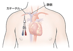 心臓が表示された、中心線が入った男性の胸の輪郭。