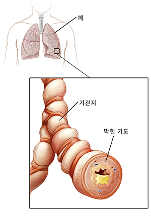 기도와 폐가 보이는 인체 흉부의 대략적 모습. 염증과 점액으로 찬 기관지의 근접 모습.