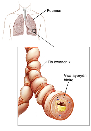 Yon kontou lestomak yon moun ki ap moutre trache li ak poumon li yo. Yon gwo plan sou tib bwonch lan ki moutre enflamsyon ak akimilasyon rim nan.
