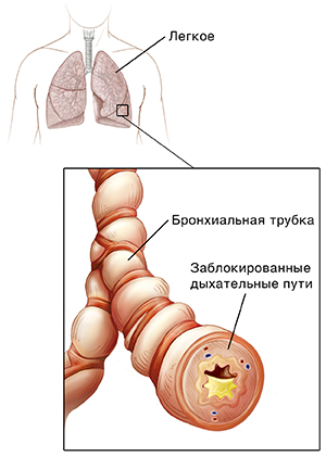 Изображение человеческой груди с трахеей и легкими. Изображение бронха крупным планом с воспалением и скоплением слизи.