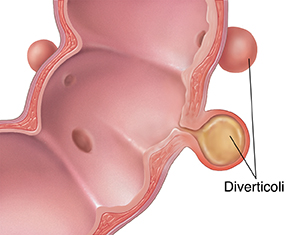 Sezione trasversale del colon sigmoideo con diverticolite.
