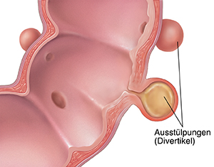 Querschnitt eines Colon sigmoideums mit Divertikulitis.