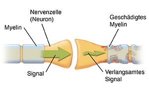 Vergrößerte Darstellung einer Synapse, an der zwei Nervenzellen (Neuronen) zusammentreffen. Die Pfeile zeigen die Richtung an, in der das Signal durch eine gesunde Nervenzelle übertragen wird und wie die Signalübertragung an der geschädigten Nervenzelle unterbrochen wird.