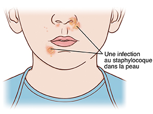 Gros plan de la partie inférieure du visage et du cou d'une personne. Des lésions sur le nez et la bouche causées par l'infection au staphylocoque.