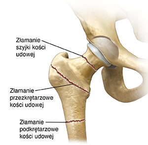 Widok stawu biodrowego od przodu pokazujący trzy typy złamania.