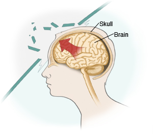 Illustration of the head that shows movement of the brain inside the skull when the head hits a wall.