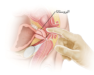 صورة جانبية لأعضاء الحوض الذكرية تُظهر كيفية إجراء فحص المستقيم بالإصبع.