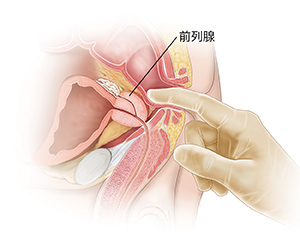 显示数字化直肠检查的男性盆腔器官侧视图。