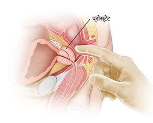 डिजिटल रेक्टल परीक्षा दिखाते हुए पुरुष श्रोणि अंगों का साइड व्यू।