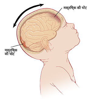 सिर को पीछे की ओर झुकाए, मस्तिष्क को अंदर से दिखाते हुए, शिशु का साइड व्यू। तीर सिर को आगे-पीछे चलते हुए और मस्तिष्क के आगे और पीछे की चोटों को दिखाते हैं।