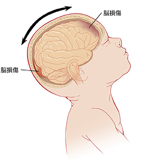 頭を後ろに傾けた赤ちゃんとその脳を示した側面図。矢印は頭が前後に動いていることと、脳の前後に損傷があることを示しています。