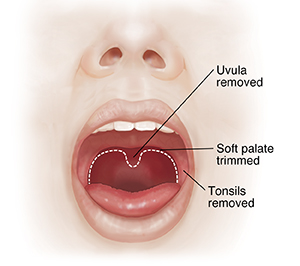 Open mouth showing soft palate tissues to be removed.