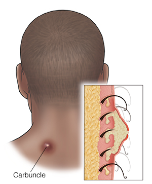 Back view of dark-skinned man's head and neck with carbuncle on neck. Inset shows cross section of carbuncle.