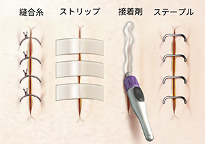 縫合糸、ステリストリップ(外科用テープ)、接着剤、およびステープルの拡大図。