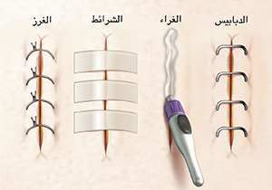 صورة مقربة للشقوق الجراحية تُظهر الغرز، والشرائط المعقمة، والغراء، والدبابيس.