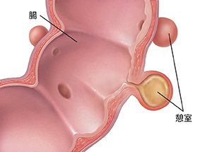 腸壁の憩室袋を示す腸の断面図。