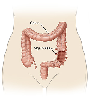 Outline ng ibabang katawan na ipinakikita ang colon at mga bulsa ng diverticulosis.