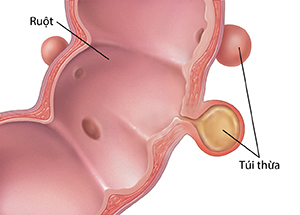 Mặt cắt của ruột thể hiện túi thừa trên thành ruột.