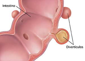 Corte transversal del intestino donde se observan divertículos en la pared intestinal.