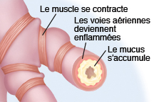 Coupe transversale de bronchiole montrant la voie respiratoire majoritairement bloquée par le mucus, l'inflammation et la constriction musculaire.