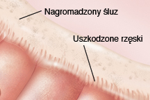 Komórki z uszkodzonymi rzęskami powodują gromadzenie śluzu i cząsteczki w śluzie.