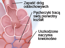 Zapadnięte oskrzela i woreczki pęcherzykowe z rozedmą płuc.