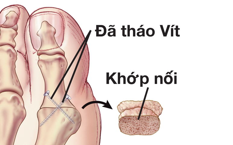 Khớp được tháo và trục ốc được thêm vào ngón chân cái