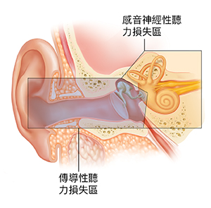 耳朵的剖面圖,顯示外耳、內耳和中耳結構。彩色塗層顯示導致傳導性和感覺神經性聽力損失的區域。