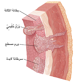 مقطع عرضي لجدار المثانة يُظهر البطانة، والأنسجة تحت المخاطية، والعضلة، والدهون، بالإضافة إلى ثلاثة أنواع من السرطان: الأورام الحليمية والأورام اللاطئة والسرطانة اللابدة.