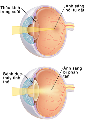 Hình vẽ ba phần tư của mắt cho thấy ống kính tập trung ánh sáng mạnh. Hình vẽ ba phần tư của mắt cho thấy ánh sáng tán xạ đục thủy tinh thể.