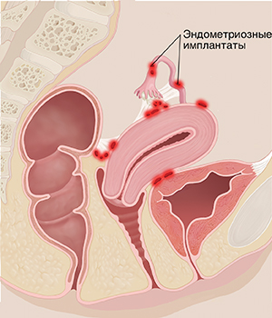 Поперечное сечение таза женщины сбоку: показаны области, воспаленные вследствие эндометриоза.