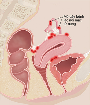 Mặt cắt ngang khung chậu của người phụ nữ cho thấy các khu vực bị viêm do lạc nội mạc tử cung.