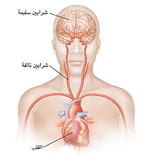 صورة أمامية للرأس والجزء العلوي من الجسم تُظهر الشرايين السباتية والدماغ.